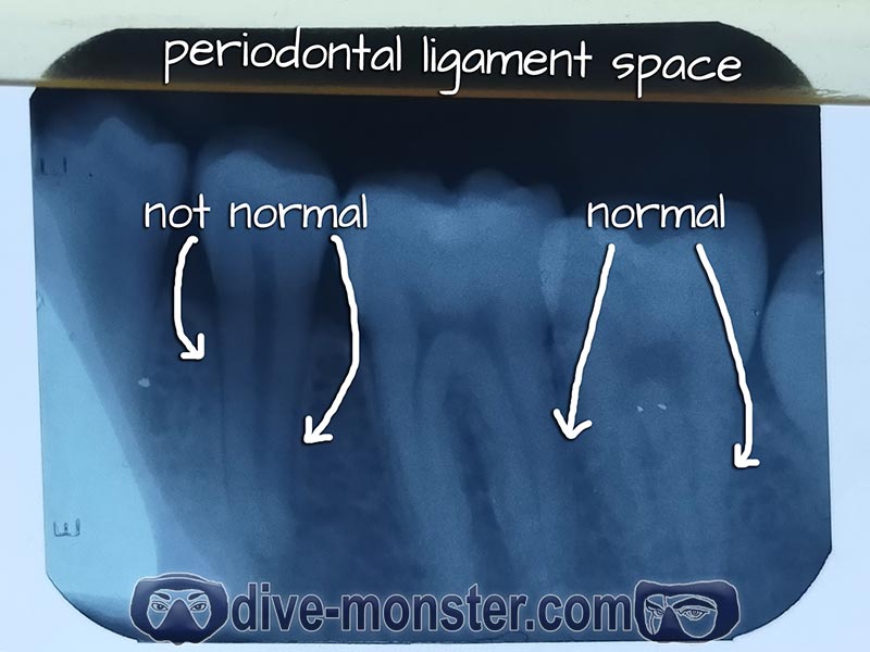 Daisy's x-ray periodontal ligament space